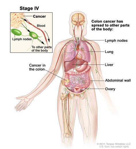 Abdominal Wall Lymph Nodes | MedicineBTG.com