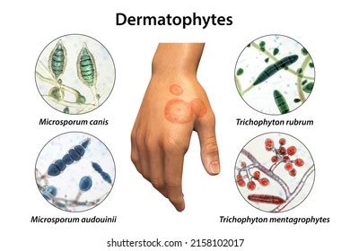 460 Microsporum Images, Stock Photos & Vectors | Shutterstock