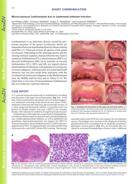 (PDF) Mucocutaneous Leishmaniasis due to Leishmania infantum Infection