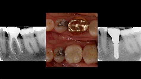 Surgical Extraction & Immediate Dental Implant Placement -Lower Left Molar. - YouTube