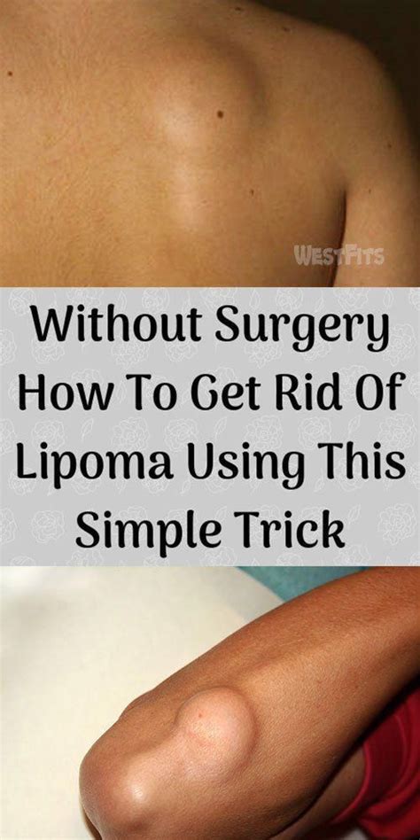 Without Surgery How To Get Rid Of Lipoma Using This Simple Trick # ...