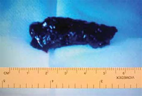 Endobronchial blood clot which was removed with Fogarty catheter | Download Scientific Diagram