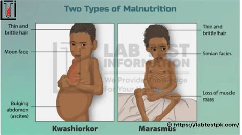 Marasmus Disease