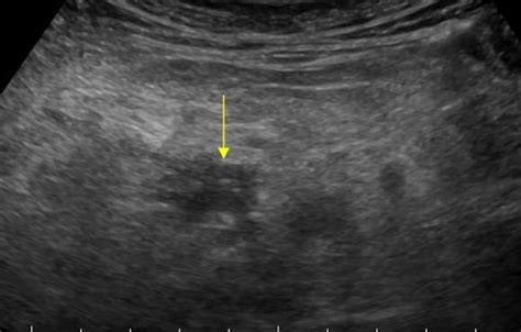 Abdomen and retroperitoneum | 1.7 Peritoneum mesentery and omentum : Case 1.7.4 Mesenteric ...