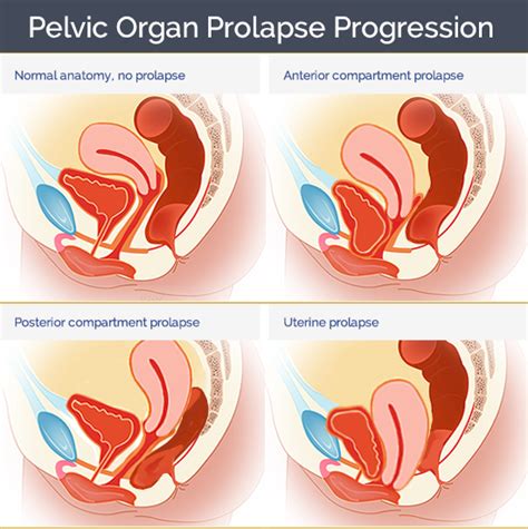 Pelvic organ prolapse - Mohamed Elnasharty