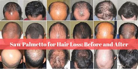 Saw Palmetto for Hair Loss: Before and After [How it Works]