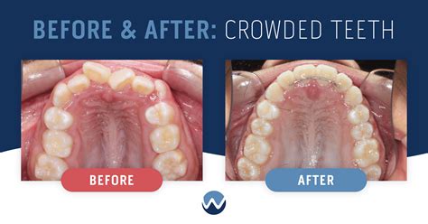 Ways We Can Help With Teeth Crowding • Woodhill Dental Specialties