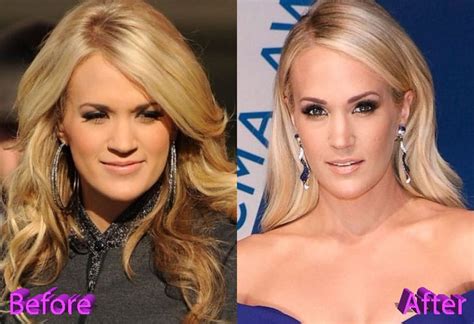 Carrie Underwood Before and After Cosmetic Surgery