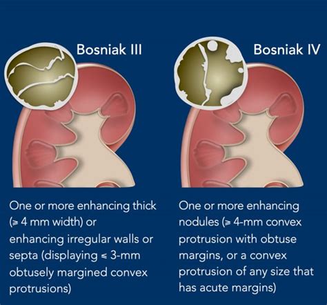 The Radiology Assistant : Bosniak Classification 2019