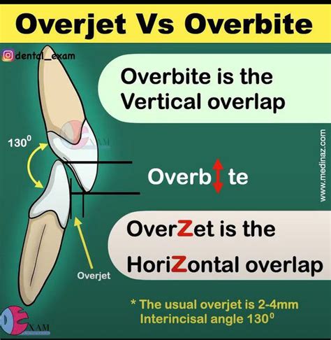 Overjet Vs Overbite - MEDizzy