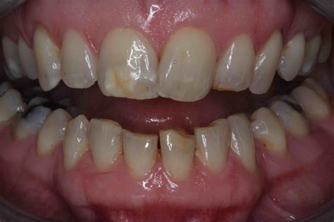 Tooth Bonding For Discolored Teeth at Nancy Watson blog