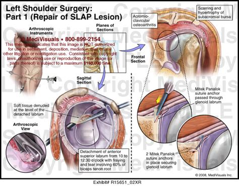 Left Shoulder Surgery- Part I - Repair of SLAP Lesion