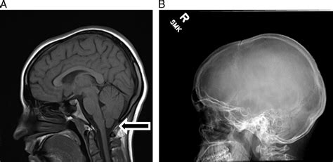 Chiari Malformation in the Concussion Clinic: Diagnosis and ...