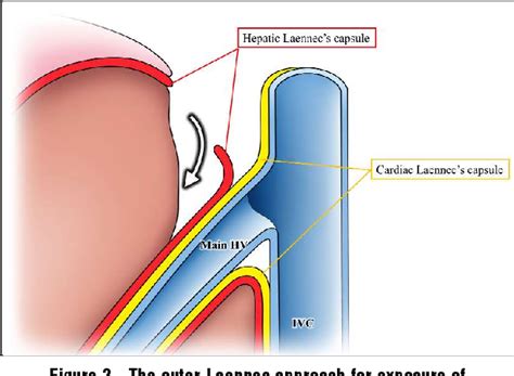 Figure 3 from Histology of the Laennec's Capsule Around the Hepatic Veins and How it May Guide ...