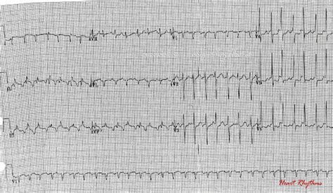 ECG Rhythms: A long RP tachycardia with alternating cycle length