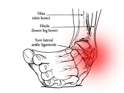 'Ankle Injuries – Inversion of the ankle ligament' By Jade Blake, Physio4Life Senior ...