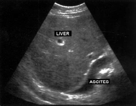 Abdominal Ultrasound showing hepatosplenomegaly | Download Scientific Diagram