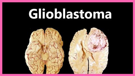 Glioblastoma Types Symptoms Causes Treatment And Diagnosis | The Best Porn Website