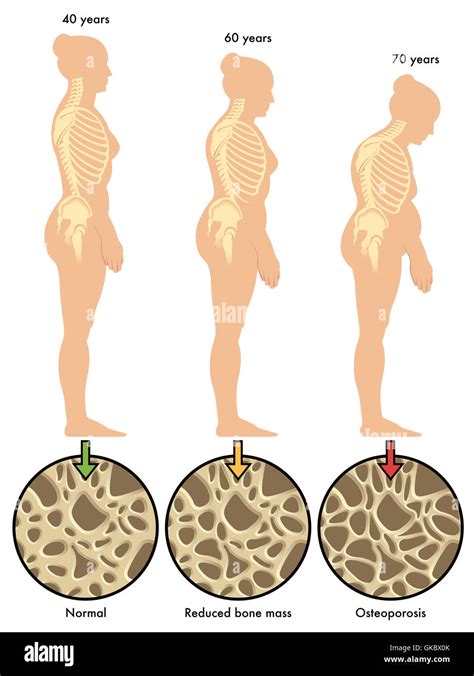 Menopause as related to Calcium - Pictures