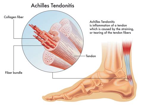 Achilles Tendon Pain - Causes, Treatments & Prevention