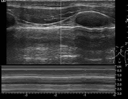 Picture Of Pneumothorax M Mode Ultrasound