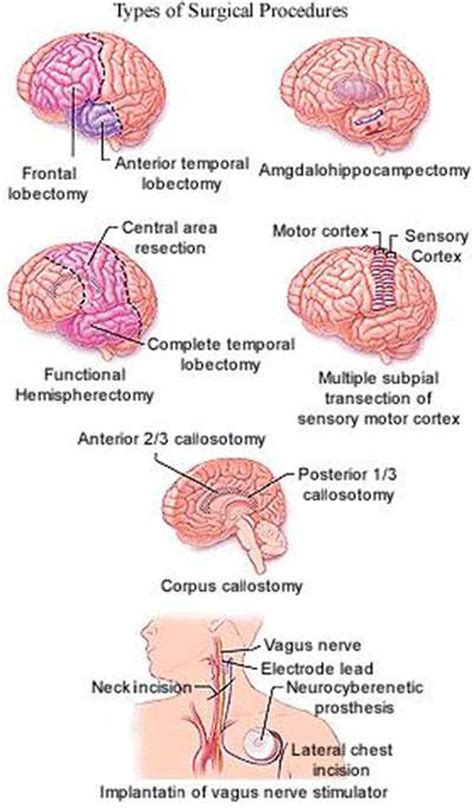 Types of Epilepsy Surgery - MEDizzy