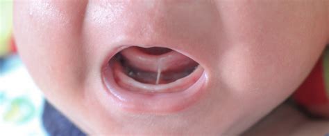 What is a tongue tie? What are the symptoms? How does it go? - Health