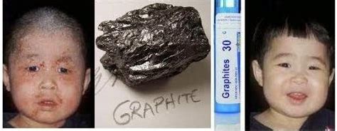 Homeopathy Medicine : Graphites Medicine for Skin Deseases