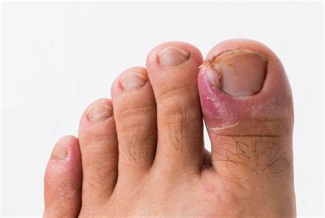 All About Ingrown Toenails - Round House Podiatry