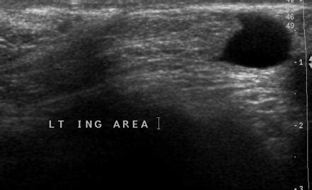 Indirect Inguinal Hernia Ultrasound