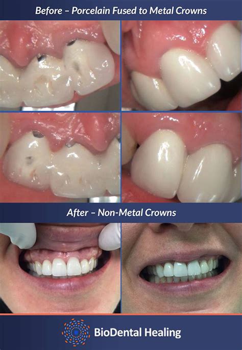 Crown Replacement Newbury Park, Non-Metal Crowns, Metal Free Dentistry