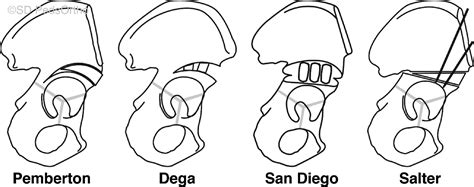 View of Comparison of Acetabular Morphology Changes After Pediatric Pelvic Osteotomies Using ...