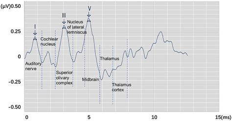 Frontiers | Automatic Recognition of Auditory Brainstem Response Characteristic Waveform Based ...