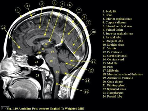 CT brain | Radiology imaging, Mri, Brain anatomy