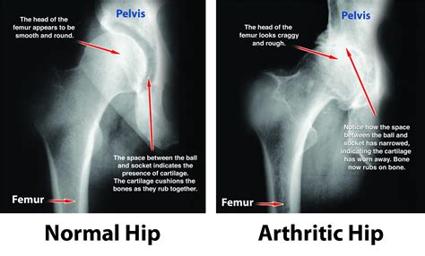 Normal hip vs hip dysplasia xray - polfsales