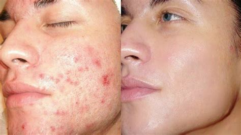 How To Remove Acne Marks & Acne Scars - YouTube