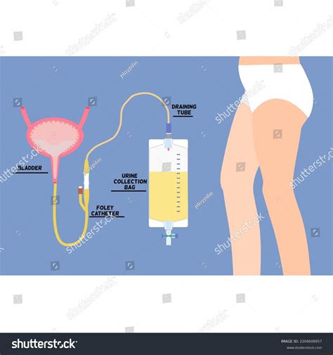 Suprapubic Catheter Female