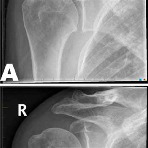 (A) Pretreatment radiological examination showing glenohumeral... | Download Scientific Diagram