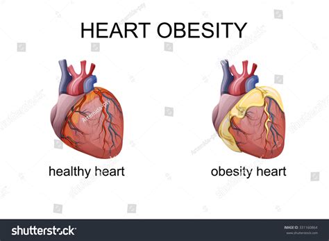 Illustration Obesity Heart Comparison Stock Vector (Royalty Free) 331160864 | Shutterstock