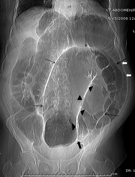 Sigmoid Volvulus | Journal of Hospital Medicine