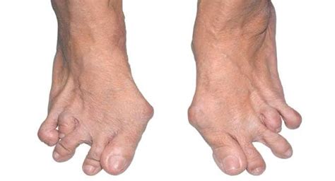 How rheumatoid arthritis affects the foot and ankle | TheHealthSite.com