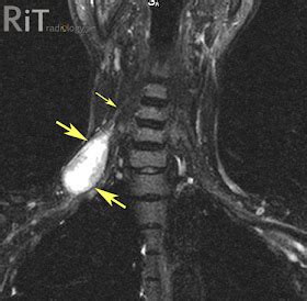 RiT radiology: Primary Brachial Plexus Tumor