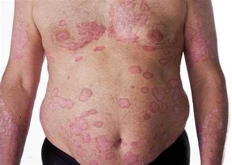 Psoriasis is a long-lasting autoimmune disease cha