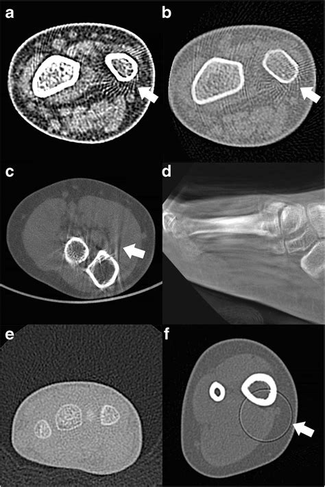 Examples of various CT artifacts. a and b Aliasing artifacts in an MDCT ...