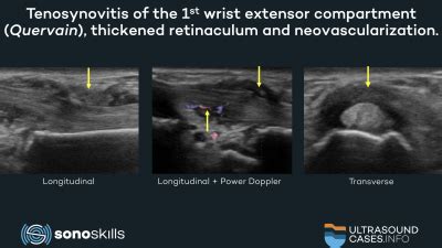 De Quervain's Ultrasound