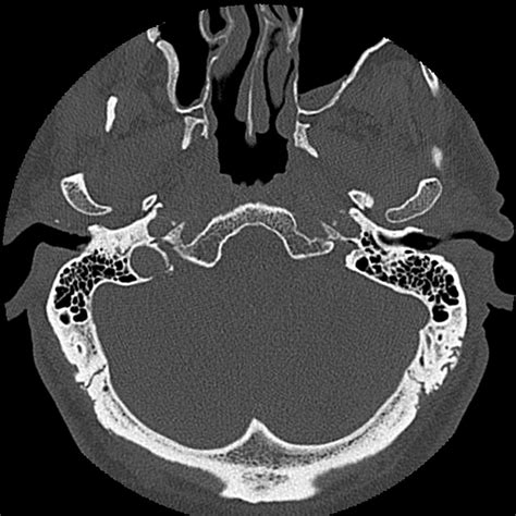 Temporal Bone Ct Anatomy - Anatomical Charts & Posters