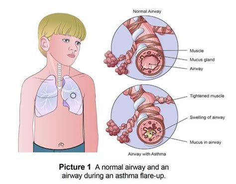 Asthma and Reactive Airway Disease: Symptoms and Treating Flare-ups | Reactive airway disease ...