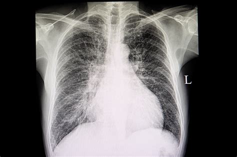 A Chest Xray Film Of A Patient With Congestive Heart Failure Stock Photo - Download Image Now ...