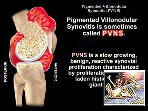 Pigmentirani vilonodularni sinovitis (PVNS): vrste, simptomi i još ...