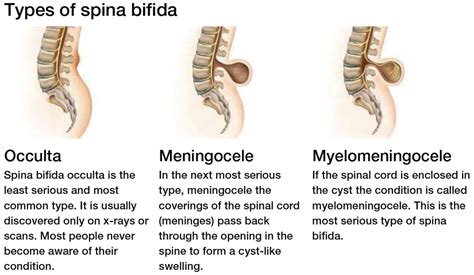 Diagnosis Focus: Spina Bifida | Shield HealthCare